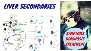 Cancer Metastasis in the Liver; Symptoms Diagnosis Treatment