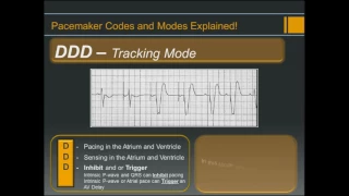 Pacemaker Codes and Modes - Explained