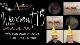 7CM EAR WAX REMOVAL FOR EPISODE 700! - EP700