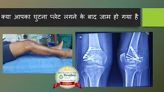 क्या आपका घुटना प्लेट लगने के बाद जाम हो गया है Arthroscopic Treatment of Stiff Knee-Hoffa Fracture