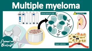 Multiple myeloma | Pathology, genetics and treatment of Multiple myeloma | MGUS | USMLE