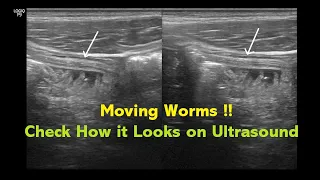 Intestinal Helminthiasis (Ascariasis) || Ultrasound || Case 04