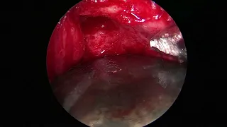 left orbital tumor, Endoscopic transorbital superior eyelid approach, 202207