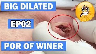 Blackheads Two Big Dilated Pores of Winer EP02!!
