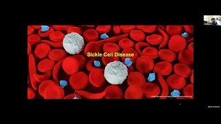 Sickle Cell Disease: Past, Present and Future