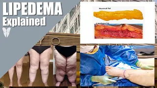 What is Lipedema and How is Lipedema Treated? | Total Lipedema Care | Dr. Jaime Schwartz