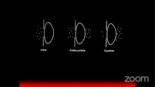 uveitis course I