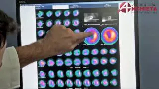 Cintilografia: diagnóstico por imagem - Medicina Nuclear