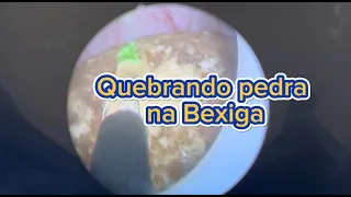 Quebrando Pedra na Bexiga - Cistolitotripsia Endoscópica a Laser | Dr. Petronio Melo