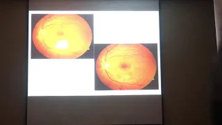 Approach to posterior uveitis Amod Gupta, India