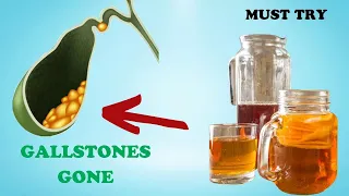Say Goodbye to Gallstones: 5 Vitamins That Can Help Dissolve Them | Healthy Care