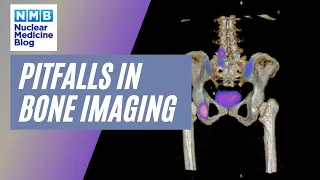 Nuclear Medicine | RFLNMA | Pitfalls in Bone Imaging