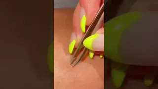 Satisfying pimple and cyst popping! || #shorts #tiktok #acnetreatment #acne