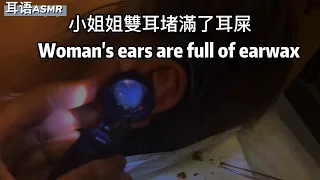 從耳朵裡面夾到的大塊耳垢 ▎Large pieces of earwax caught from inside the ear▎耳の中から引っかかった大きな耳垢  ▎귀에 큰 귀지가 끼임