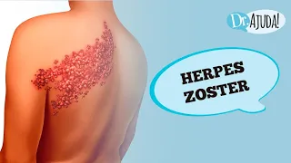 BOLHAS, FERIDA E DOR: O QUE É HERPES ZOSTER? | Dr Ajuda