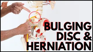 Best Exercise for L4-L5 Disc Bulge & L4-L5 Herniation- Includes Self Tests