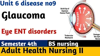 Glaucoma: Open-Angle, Closed-Angle, Symptoms, Pharmacology, Pathophysiology Nursing lecture