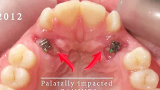 HOW #BRACES WORK - #TIMELAPSE of Impacted Canines - 6 MONTHS treatment, BEFORE and AFTER