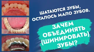 Шатаются зубы, осталось мало зубов. Зачем объединять (шинировать) зубы?