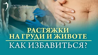 Как избавиться от растяжек на груди и животе? Современные способы удаления растяжек