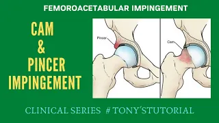 FEMEROACETABULAR IMPINGEMENT# Cam & Pincer Impingement