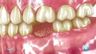 Consequencias da perda de um dente 1