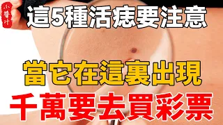 這5種活痣要注意，當它在這裏出現，千萬要去買彩票！#生活小醬汁#風水#相學