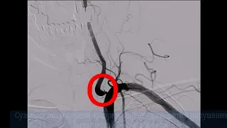 Стентирование позвоночной артерии