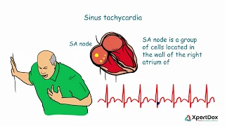 (SPANISH) - ¿Qué es la taquicardia sinusal? What is Sinus Tachycardia?