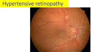 Hypertensive retinopathy explained