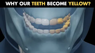 Why Our Teeth Become Yellow? (Yellow Teeth) | Teeth yellowness or discoloration