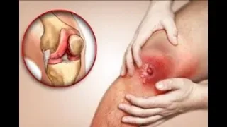 What is Septic Arthritis? Causes Signs and Symptoms of Degenerative Infective Arthritis