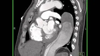 Cardiac: Aortic Type B dissection (2 of 5)