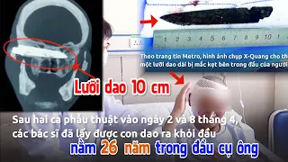 phẫu thuật gắp Lưỡi dao 10 cm nằm 26 năm trong đầu cụ ông