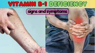 vitamins deficiency symptoms, vitamin B1 (thiamine) deficiency symptoms, vitamin b1 deficiency