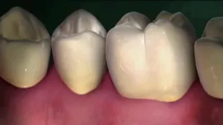 La parodontite