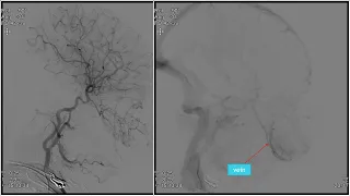 Preoperative tumor embolization  of a pediatric orbital rhabdomyosarcoma