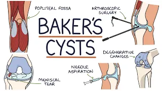 Understanding Baker's Cysts (Popliteal Cysts)