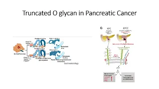 Truncated O glycans (MUC-16) and Pancreatic Cancer cells metastasis #Code: 351