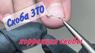 📌ВРОСШИЙ НОГОТЬ  / СКОБА 3ТО / КОРРЕКЦИЯ СКОБЫ 3ТО