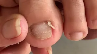 deep leg skin cutting technique#251