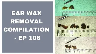 EAR WAX REMOVAL COMPILATION   EP 106