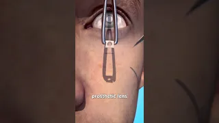 Tooth In Eye Surgery 😨 (explained)