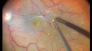 Epi-retinal Membrane removal