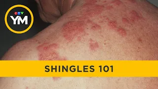 Shingles and what you need to know | Your Morning