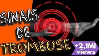 TROMBOSE: Sintomas de trombose, causas e tratamentos