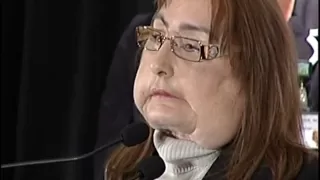 Face Transplant Recipient