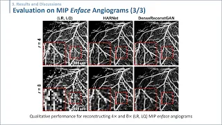 [SPIE2022] Deep Learning Enables Accelerated Optical Coherence Tomography Angiograph by Gyuwon Kim