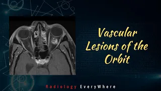 Orbital Vascular Lesions | Radiology Everywhere | Cavernous hemangioma | CCF | AVM | Radiology