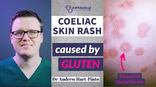 Dermatitis Herpetiformis: Skin Rash Linked To Coeliac Disease [Celiac] And Gluten Intolerance